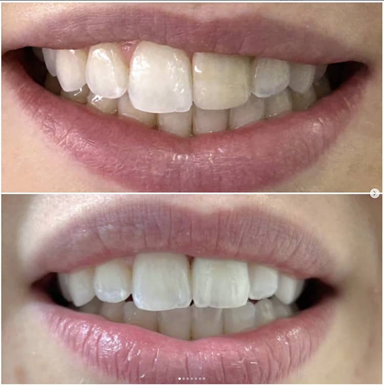 Porcelain and Zirconia Crowns