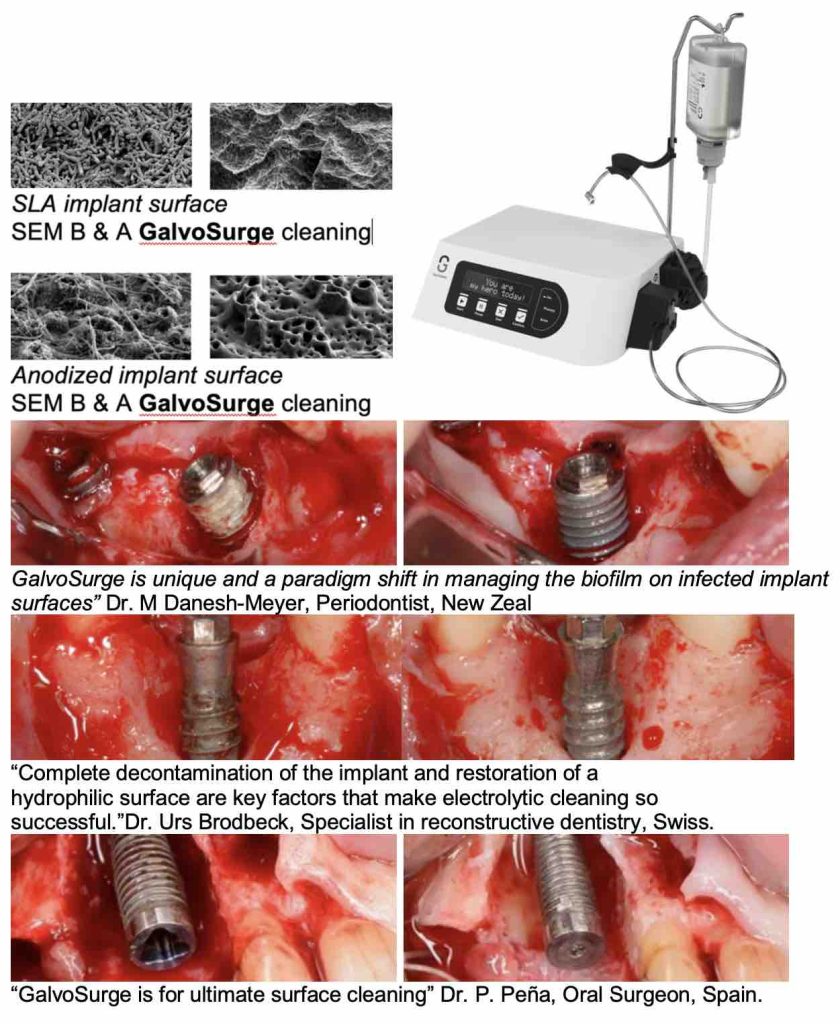 Peri-implantitis diagnosis and treatments