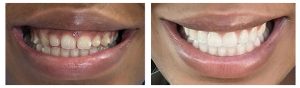 gummy-smile BEFORE AFTER