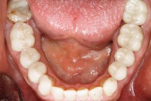 How Long Do Dental Bridges Last?