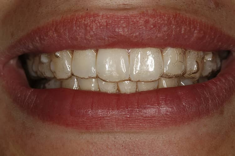 How long does invisalign take to work