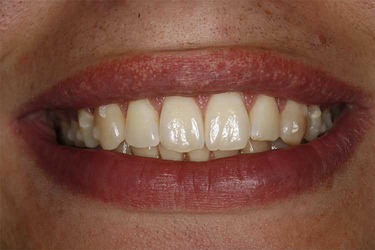 How long does invisalign take to work