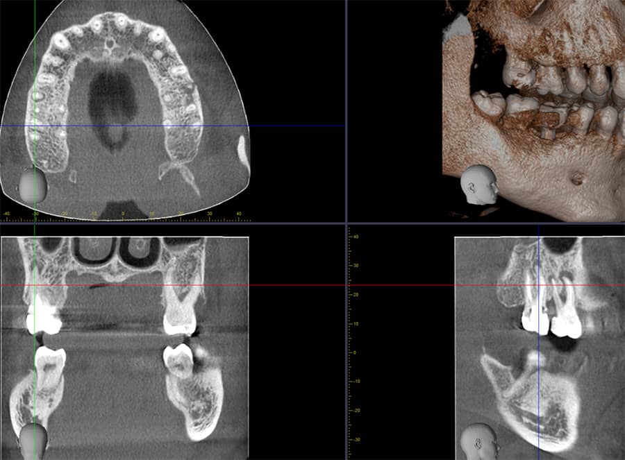 How to Avoid Root Canal?
