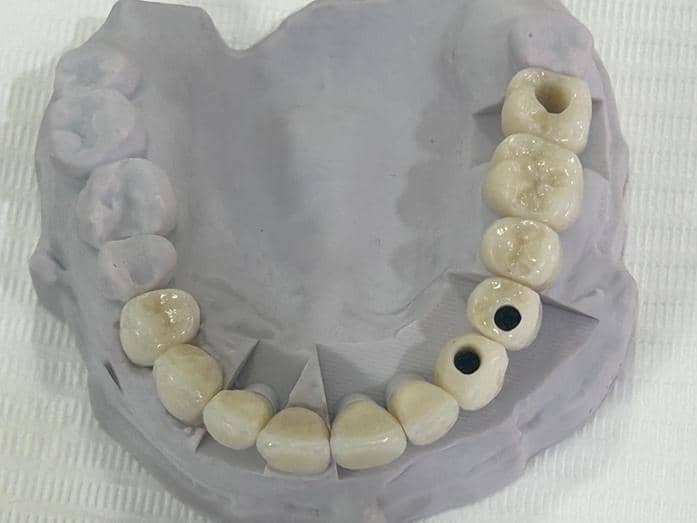 Ceramic Dental Restorations