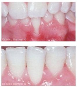 How Far Can Gums Recede Before Teeth Fall Out?