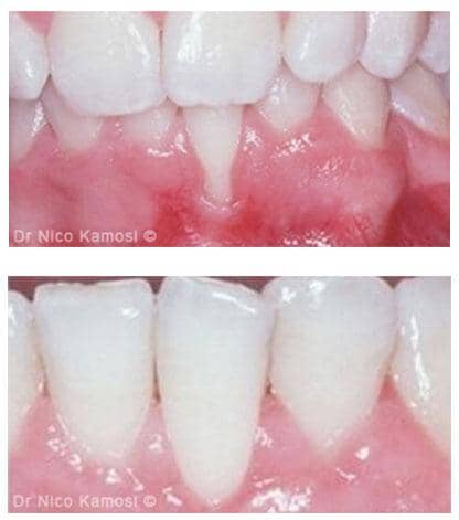 How Far Can Gums Recede Before Teeth Fall Out?