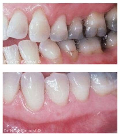 How Far Can Gums Recede Before Teeth Fall Out?