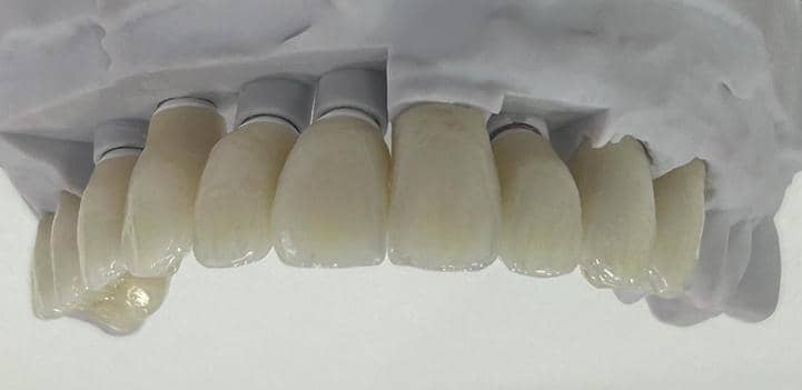 Ceramic Dental Restorations