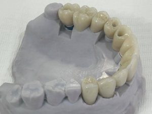 Ceramic Dental Restorations