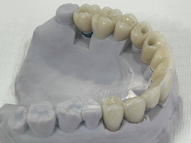 Ceramic Dental Restorations