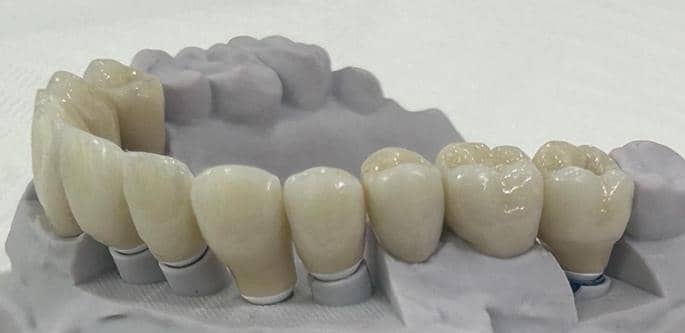Ceramic Dental Restorations