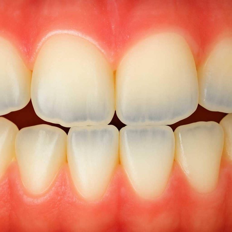 See-Through Teeth: Causes, Prevention and Treatment Explained - London ...