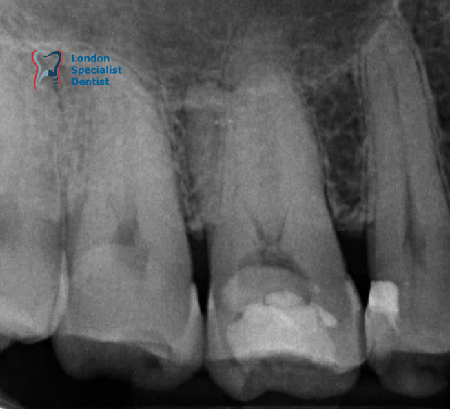 Before extraction Guided Bone Regeneration