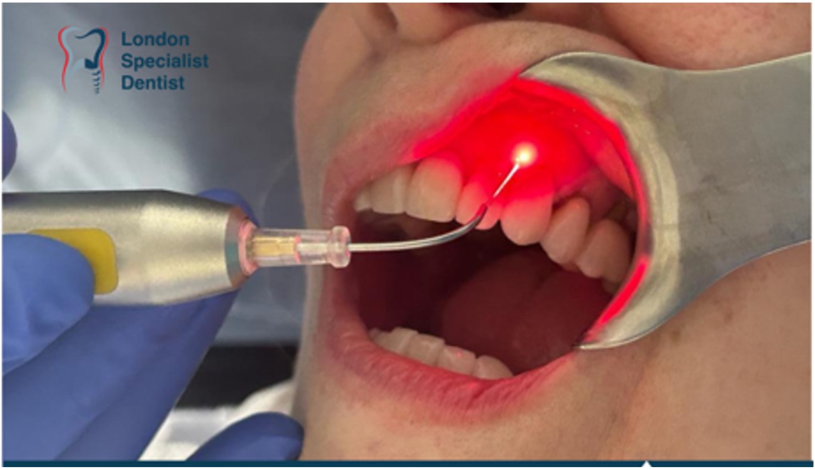 Laser-assisted periodontal