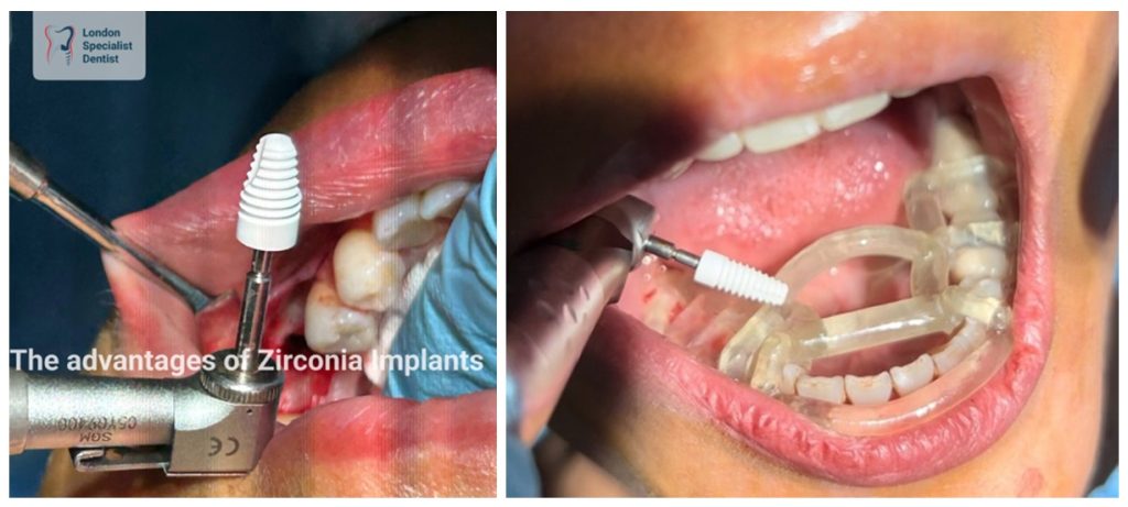 Zirconia-Implants-Holistic-approach