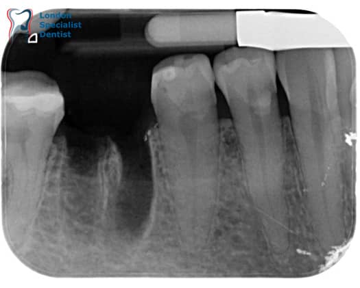 Post-Atraumatic Tooth Extraction