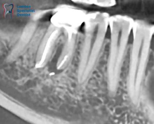 Sagittal aspect of the CBCT from infected tooth