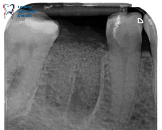 Guided bone regeneration & Ridge Preservation
