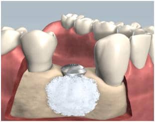 Bone regenerative procedure using bone graft material.