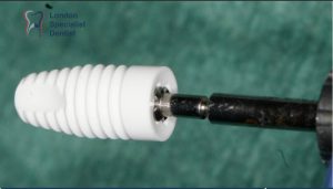 Dental Implants: Complete Guide to Costs, Procedure and Recovery